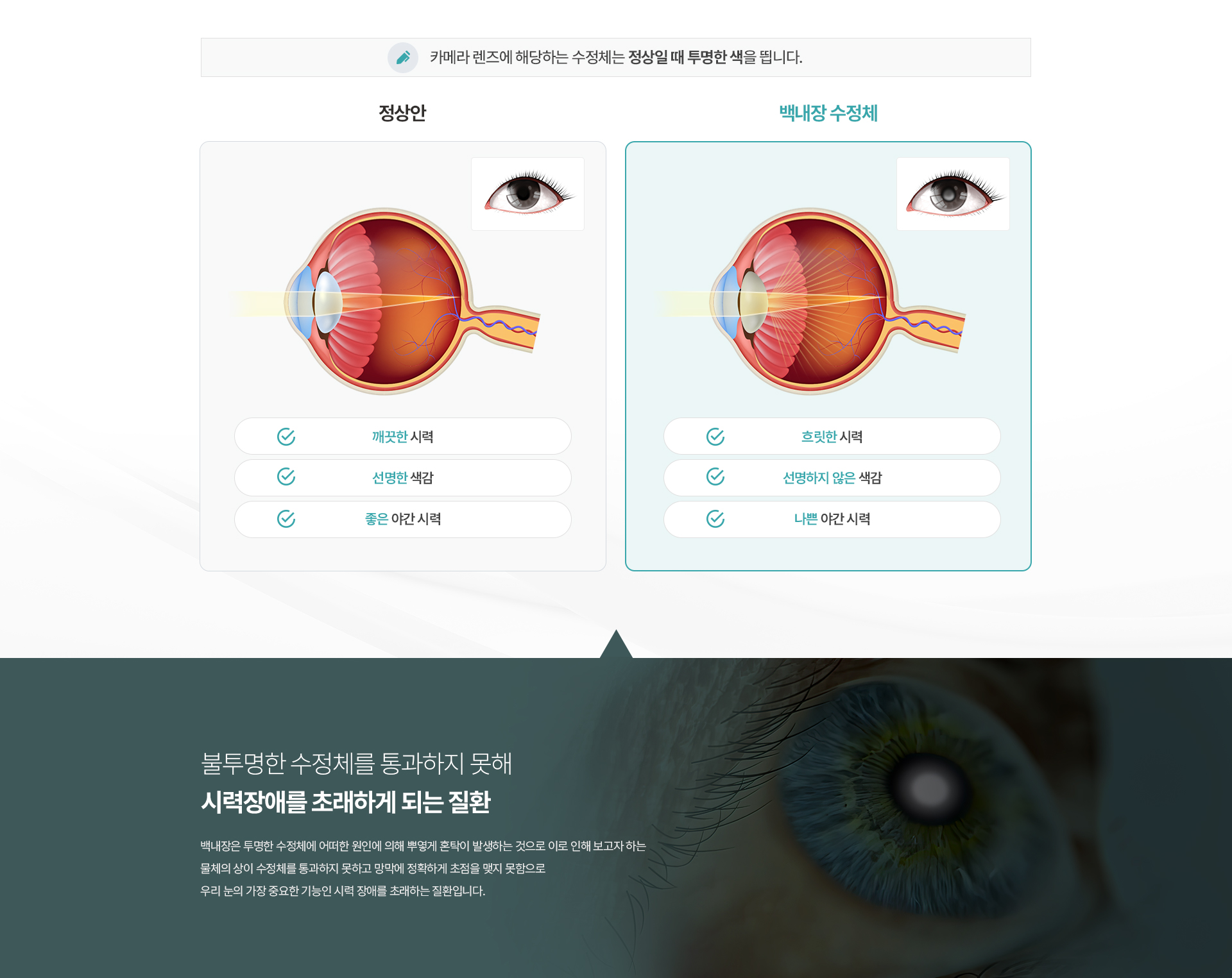 백내장 원리 알아보기