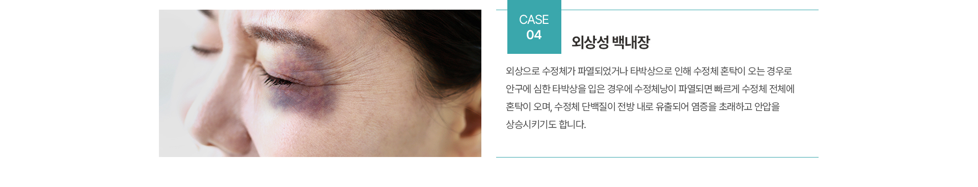 백내장 종류
