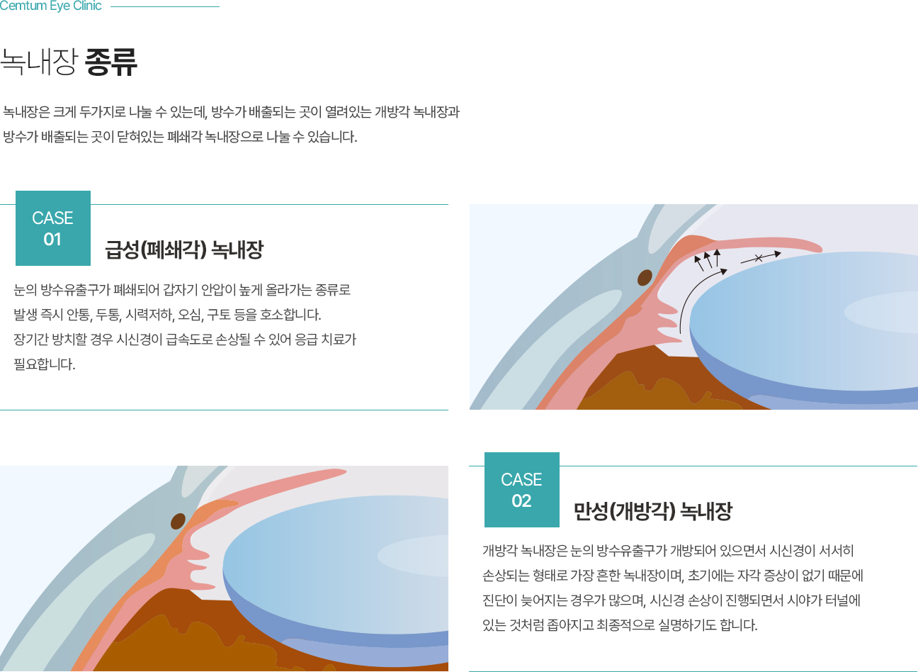 녹내장 종류