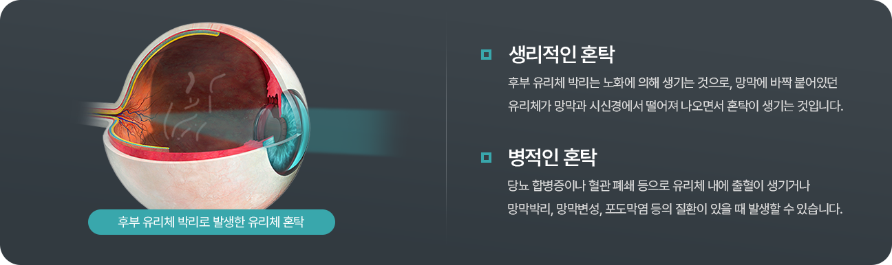후부 유리체 박리로 발생한 유리체 혼탁