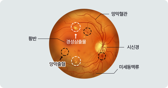 비증식성 당뇨 망막병증