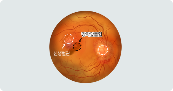 증식성 당뇨 망막병증