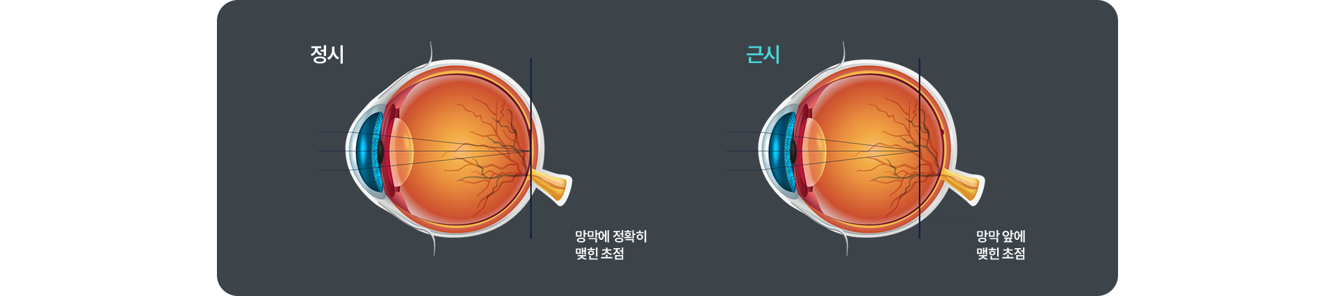 정시/근시