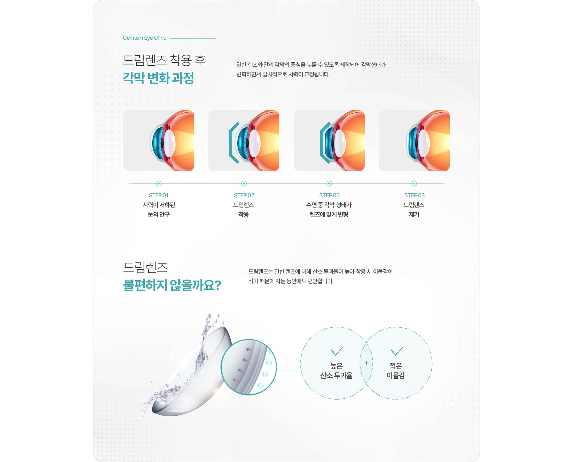 드림렌즈 착용 후 각막 변화 과정