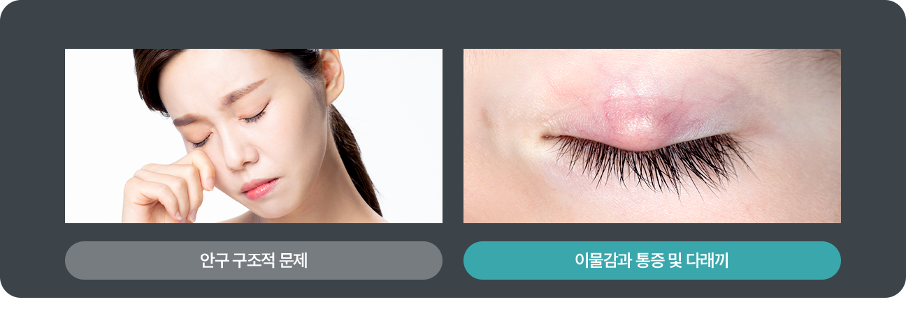 안구 구조적 문제/이물감과 통증 및 다래끼
