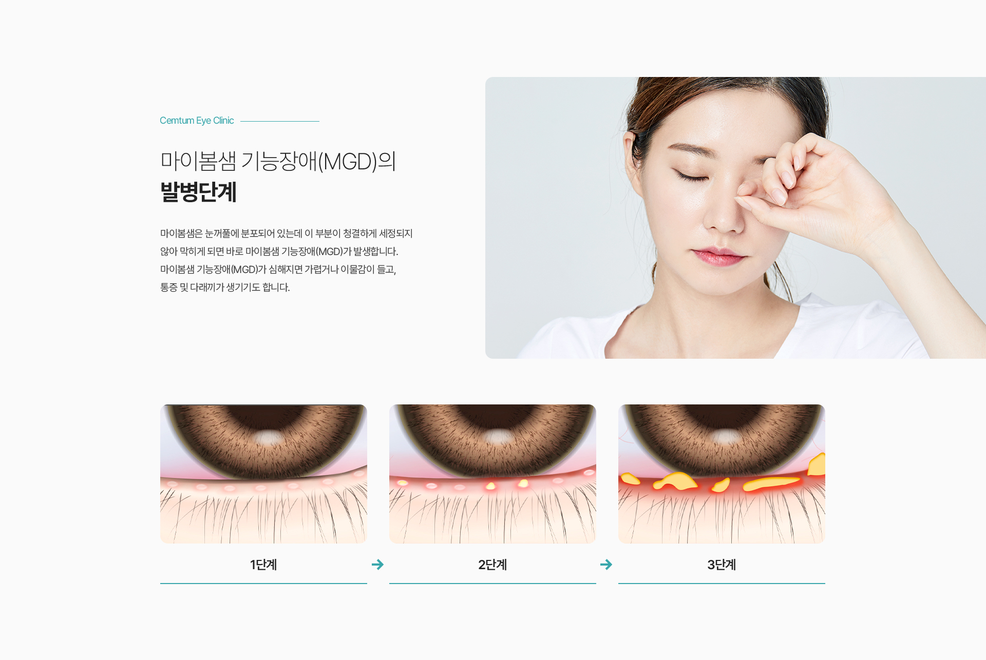 마이봄샘 기능장애(MGD)의 발병단계