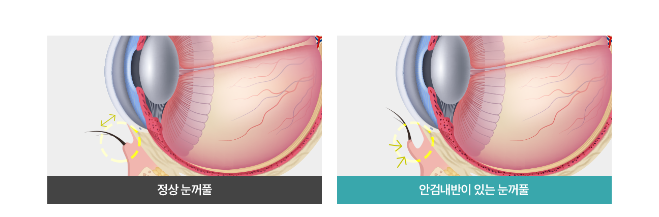 정상적인 눈/안검내반이 있는 눈꺼풀