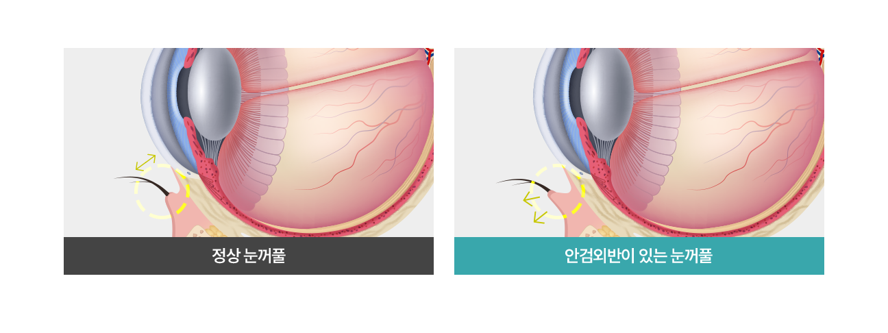 정상적인 눈/안검외반이 있는 눈꺼풀